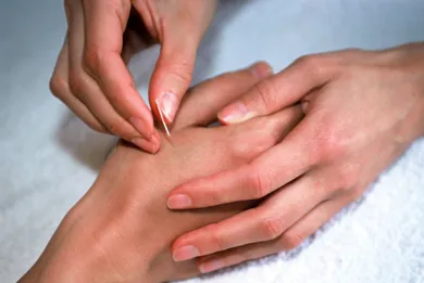 En person faar akupunktur i haanden som alternativ behandling.