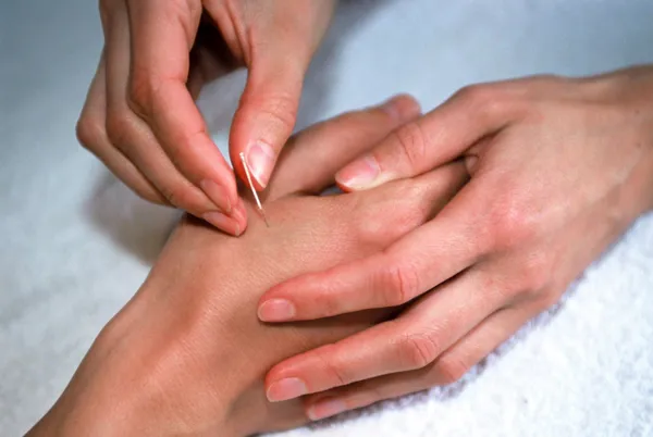 En person faar akupunktur i haanden som alternativ behandling.